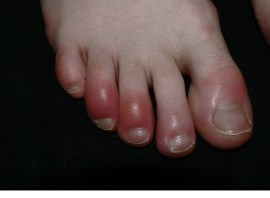 How can I alleviate chilblains?