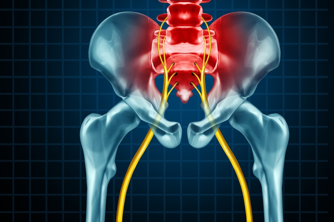 What is sciatica and how to treat it