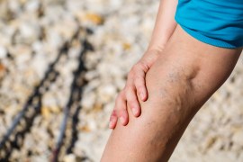 Varicose veins: What they are, causes, and how to treat them