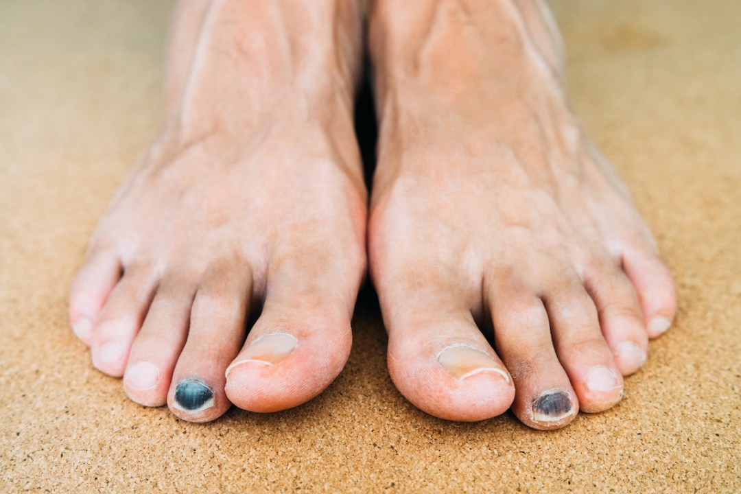 A close-up of a man's feet showing two black toenails